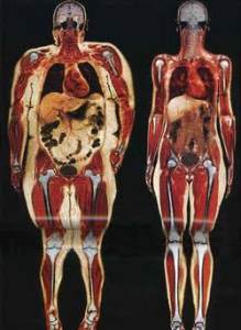 تأثير الوزن الزائد (السمنة) على الركبتين